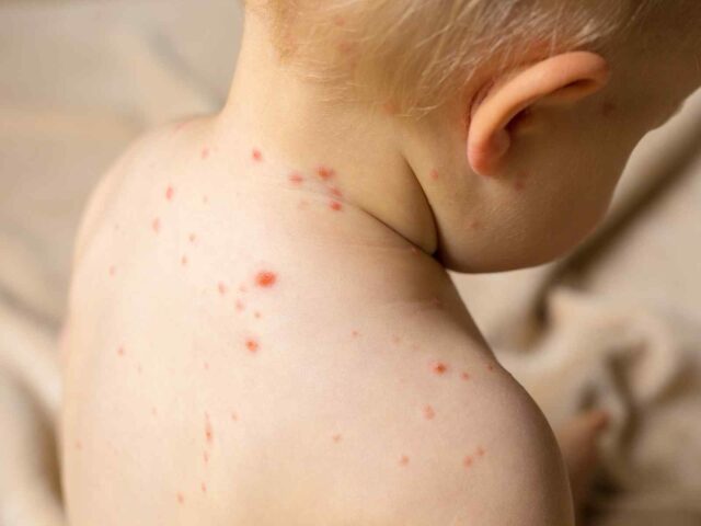 Advice: Atopic Dermatitis in Children